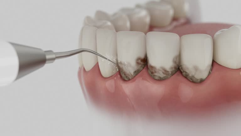 Trusted Wisdom Tooth Removal service in Bolivar, TN - Dentist Open Now